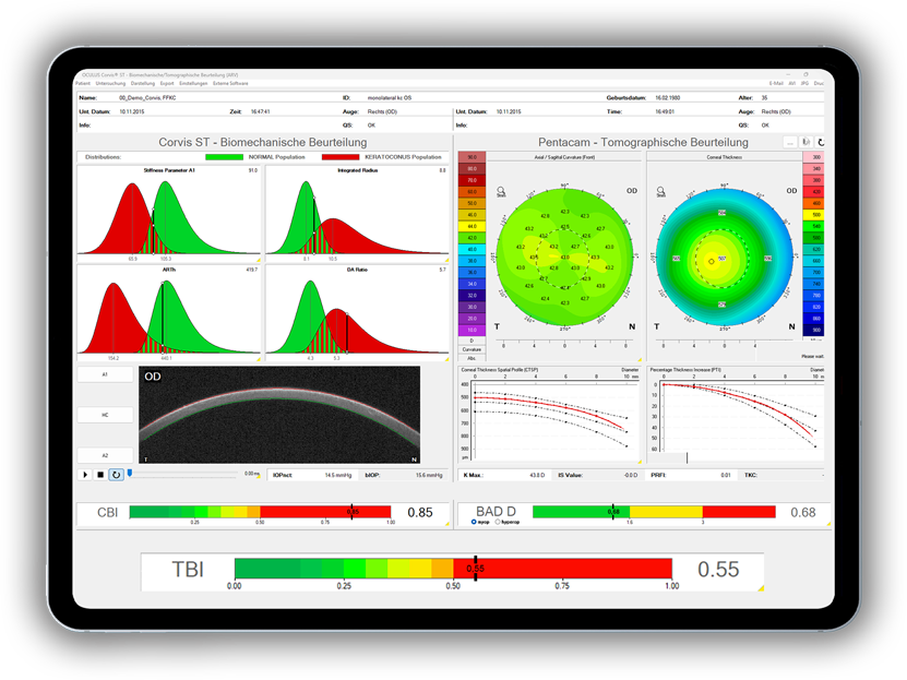 Corvis-ST-Befund mit biomechanischer und tomographischer Beurteilung der Hornhaut und TBI-Index